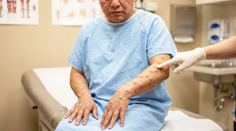 Brasil registra 48 casos de mpox em 2026; São Paulo concentra maioria das notificações